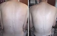 Healing Scoliosis Before & After Photo